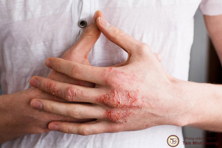 Bệnh eczema là gì? Nguyên nhân, triệu chứng và cách chữa trị - Tâm Minh Đường