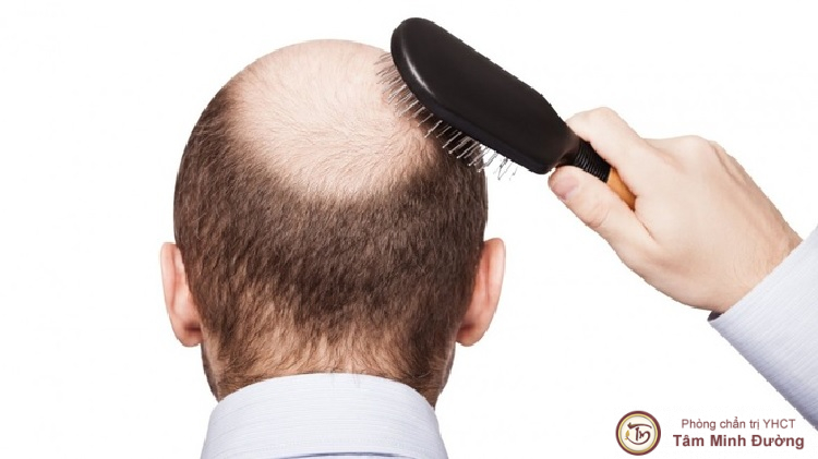 Rụng tóc nhiều biểu hiện đàn ông yếu sinh lý