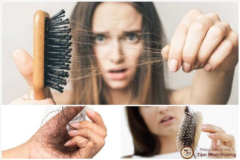 Thận yếu gây rụng tóc có nguy hiểm không? Rụng tóc nhiều là bệnh gì?
