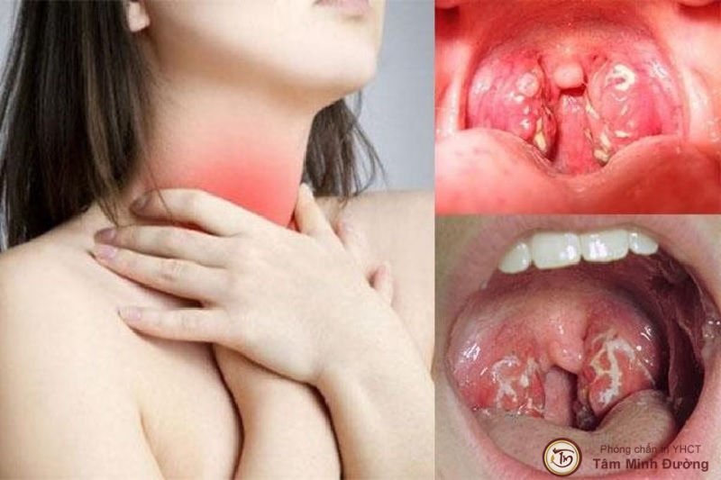 Triệu chứng viêm họng
