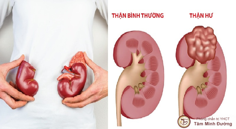 Những yếu tố nào có thể làm tăng nguy cơ mắc hội chứng thận hư?
