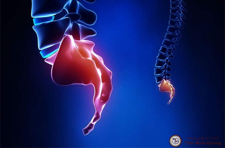 Đau vùng mông gần xương cụt là triệu chứng của bệnh gì?
