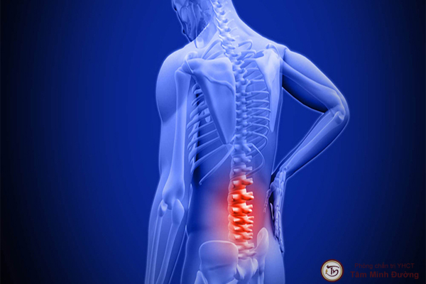 Tìm hiểu thoát vị đĩa đệm đa tầng là gì?