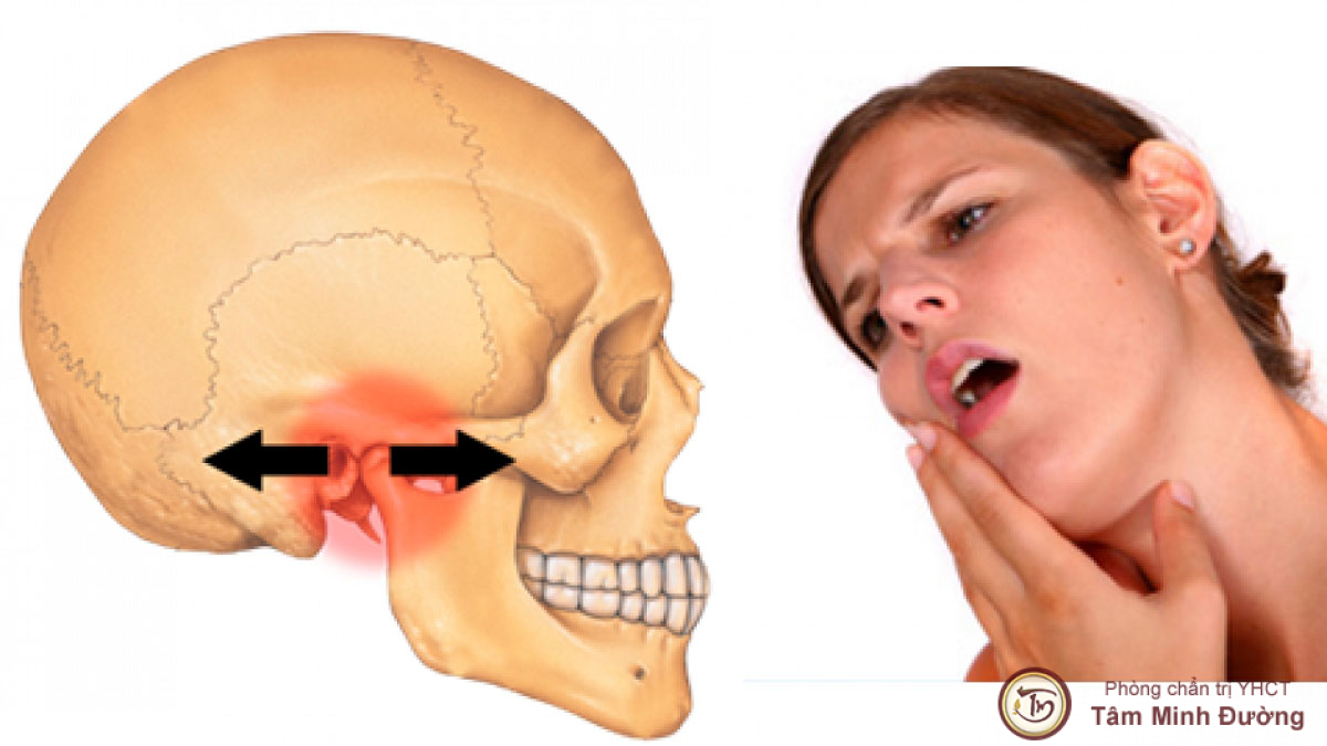 VIêm khớp thái dương hàm có thực sự nguy hiểm?