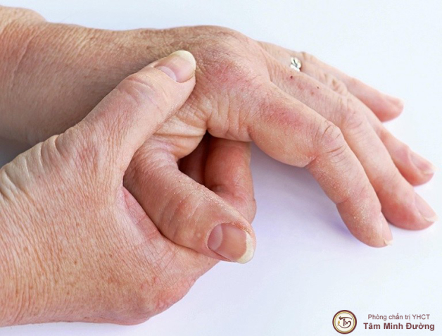 Tìm hiểu viêm khớp vảy nến là gì?