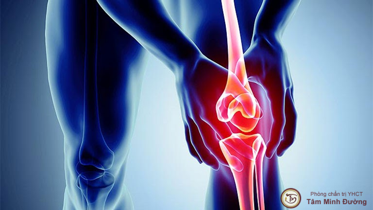Tràn dịch khớp gối là bệnh gì?