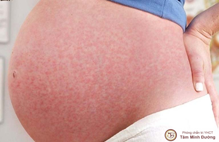Nổi mề đay khi mang thai có nguy hiểm không?