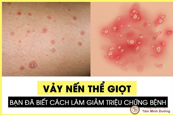 Tìm hiểu bệnh vảy nến thể giọt là gì?