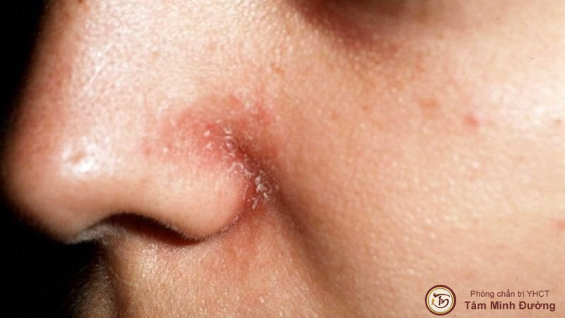 Tìm hiểu về bệnh viêm da tiết bã