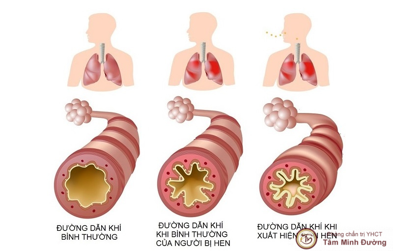 Bệnh hen phế quản có nguy hiểm không?