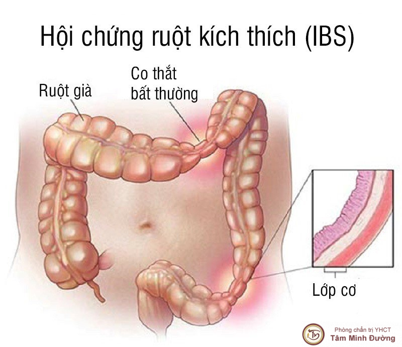 Hội chứng ruột kích thích là gì?