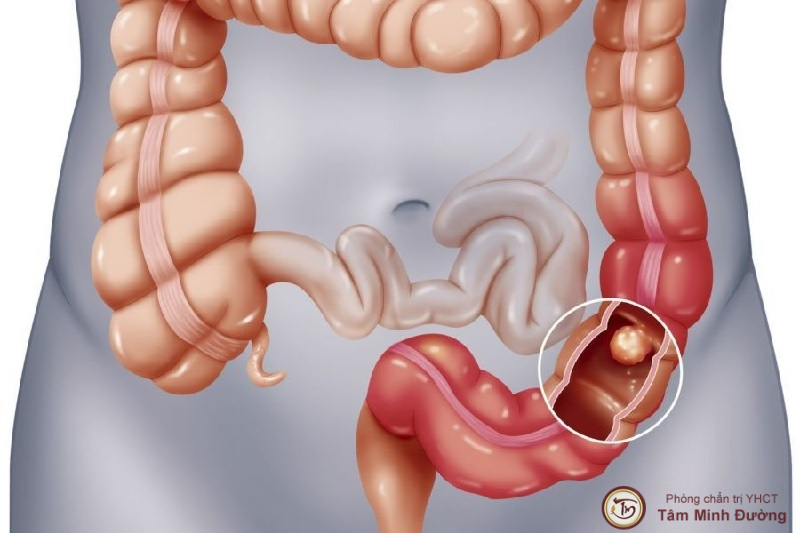 Tìm hiểu về bệnh viêm đại tràng