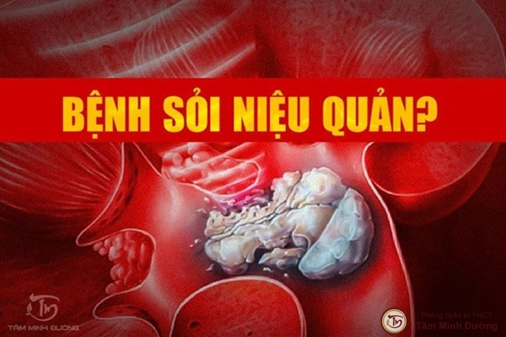 Tìm hiểu về sỏi niệu quản là gì?