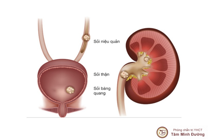 Sỏi bàng quang có nguy hiểm không?