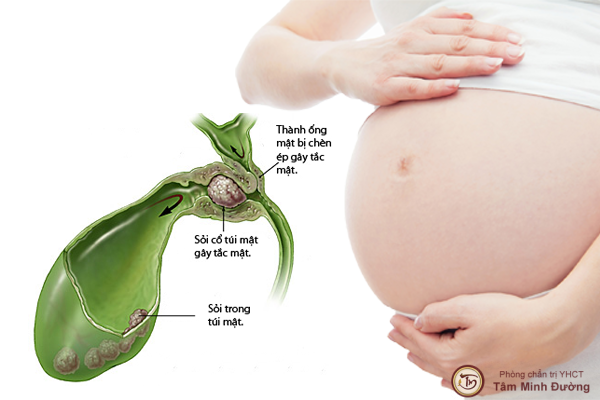 Sỏi mật ảnh hưởng như thế nào tới quá trình mang thai
