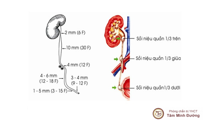 Tìm hiểu sỏi niệu quản 1/3 trên
