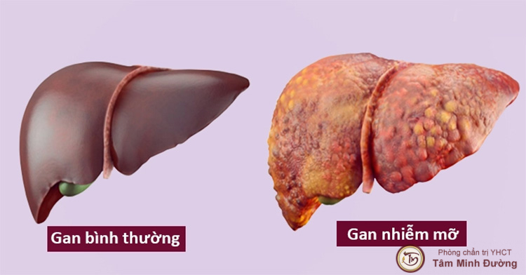 Gan nhiễm mỡ là bệnh gì và thực trạng bệnh hiện nay