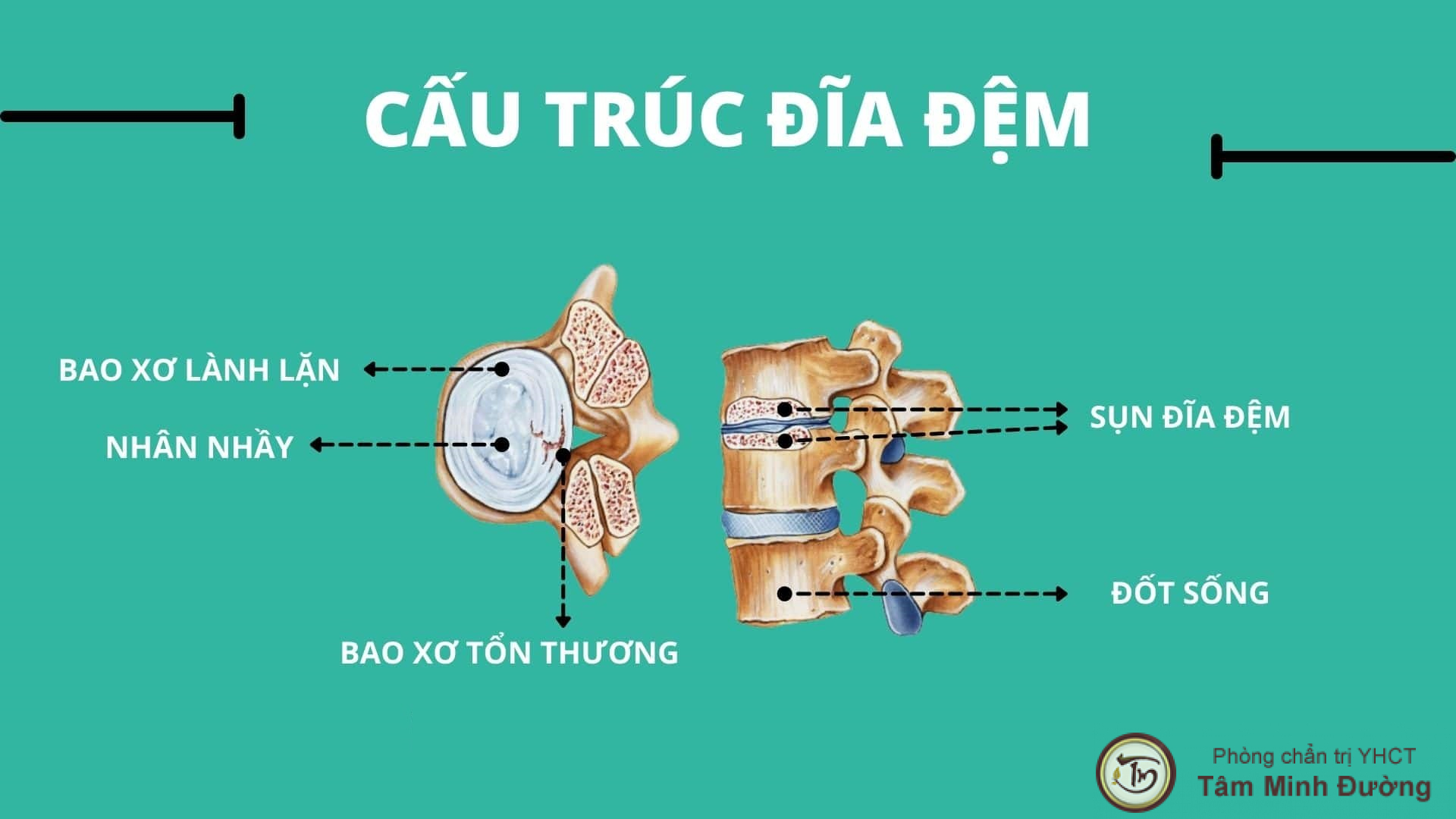 Rách bao xơ đĩa đệm có lành được không? Điều trị như nào hiệu quả - Tâm ...
