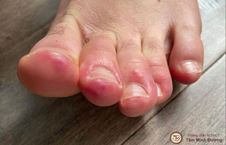 Đau đầu ngón chân có thể là triệu chứng của bệnh gì?