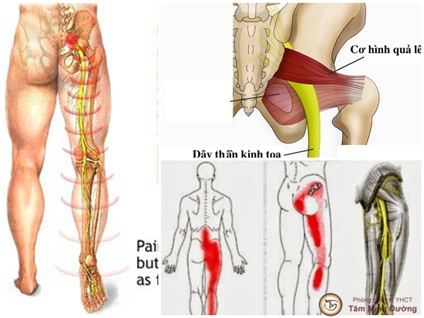 đau lưng lan xuống mông và chân