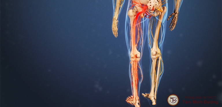 Thoái hóa cột sống có liên quan đến đau nhức từ mông xuống bắp chân không?
