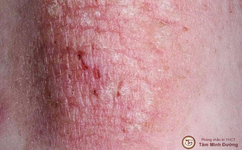 Bệnh eczema có lây không
