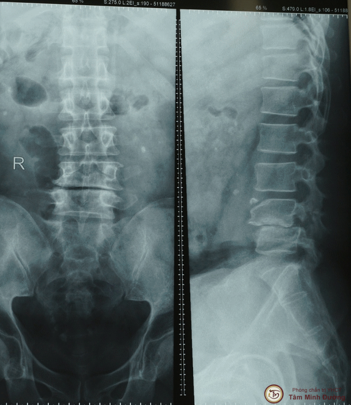Chụp X quang có phát hiện thoát vị đĩa đệm không